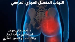 التهاب المفصل العجزي الحرقفي: ماذا ينبغي أن تعرف؟