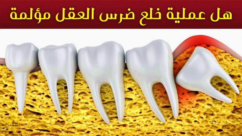 ما تحتاج معرفته عن خلع ضرس العقل: قصة تبدأ بالتخدير وتنتهي بالتعافي