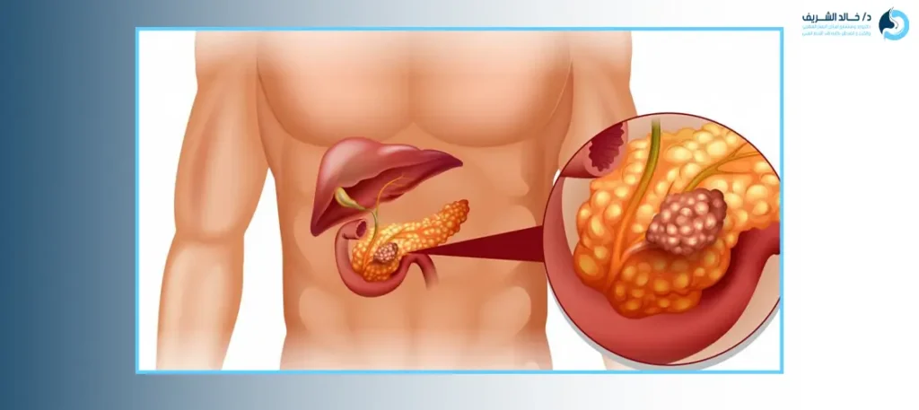 تضخّم الكبد (Hepatomegaly): هل له علاج؟